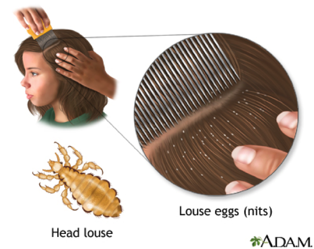 HEAD LICE 